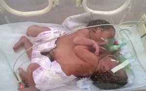 Hai bé song sinh dính liền ở Hà Giang: Khó phẫu thuật tách rời