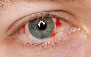 Điều trị ung thư mắt như thế nào?