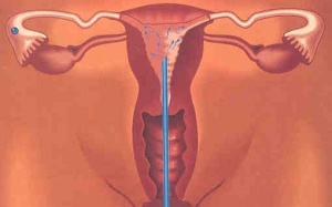 'Thả' 2 năm chưa có con, có nên thực hiện IUI?