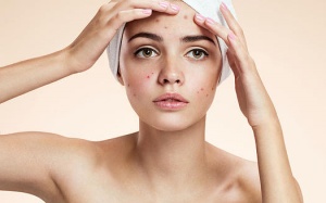 Mụn trứng cá dạng nhẹ và cách điều trị