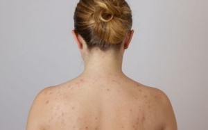 6 điều bạn nên hạn chế làm khi bị viêm nang lông