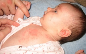 Nguyên nhân và cách phòng tránh rôm sảy cho trẻ trong mùa nóng