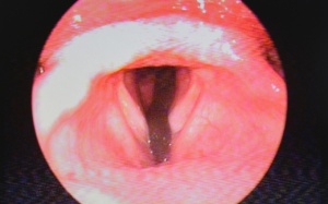 Gắp con đỉa dài 7 cm sống trong đường thở gần 2 tháng