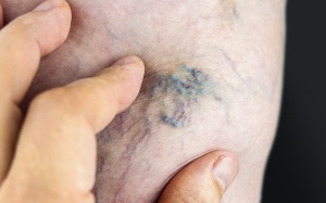 Hàng triệu người Việt có thể hoại tử chân mà không biết