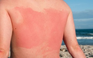 Những loại dược phẩm gây hại cho da trong những ngày nắng nóng