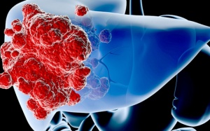 'Thủ phạm' đáng sợ khiến cả nhà 5 người đều mắc ung thư gan