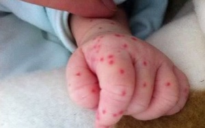 Sốt xuất huyết có lây từ người này sang người khác?