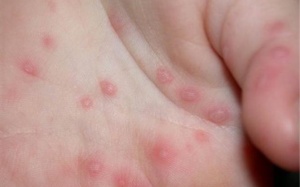 Trẻ bị sốt, mọc mụn nước do đâu?