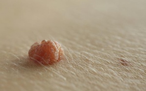 Có nên cắt bỏ mụn thịt thừa không?