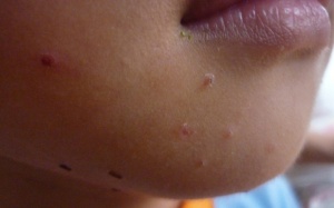 Điều trị bệnh u mềm lây như thế nào để không tái phát?