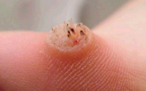 Bệnh ở chân vừa kinh vừa xấu hoành hành khi mùa mưa đang tới