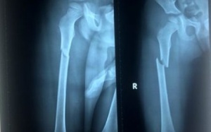 Bé trai 4 tuổi bị cha dượng và mẹ đẻ đánh gãy xương đùi