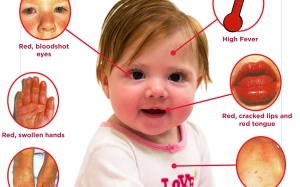 Căn bệnh lạ khó nhận biết nhưng dễ khiến trẻ tử vong