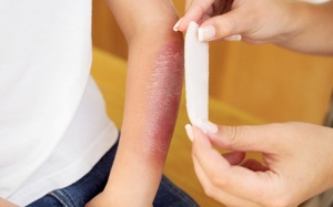 Cứ bỏng là chườm đá, xả nước lạnh: Cách sơ cứu bỏng sai lầm 