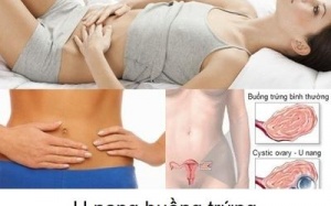 Sau phẫu thuật u nang buồng trứng, việc mang thai có bị ảnh hưởng?