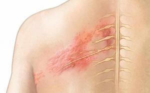 Uống thuốc nào để giảm đau bệnh zona thần kinh?