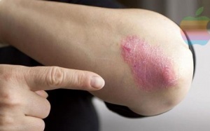 Bệnh vẩy nến – Vì đâu nên nỗi?