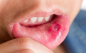 Chữa nhiệt miệng bằng nước hạt rau mùi