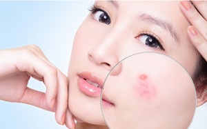 8 biện pháp thảo dược điều trị nấm ngoài da