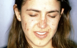 Trị mụn trứng cá do thay đổi nội tiết