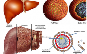 WHO quan ngại về tỷ lệ nhiễm virus viêm gan B, C ở Việt Nam