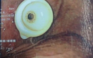 Bé 6 tuổi bị thủng thực quản do nuốt đồ chơi ở nhà trẻ