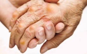 Biện pháp giảm đau khớp khi bệnh gout “hoành hành”