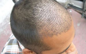 6 nguyên tắc cần biết sau khi cấy tóc