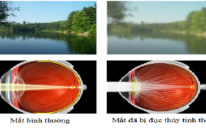 Đục thủy tinh thể do lão hóa điều trị thế nào?