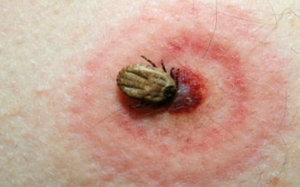 27 nghìn người mắc bệnh Lyme vì bọ ve