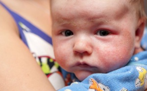 Dị ứng có di truyền không?