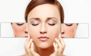 Nám da - nỗi ám ảnh dai dẳng nhưng hoàn toàn có thể xóa nhòa