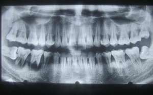 Mất mạng vì mọc răng khôn