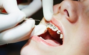 Niềng răng cho trẻ: Những điều mẹ cần biết