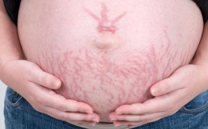 Đối phó với rạn da: 5 điều cần làm ngay và luôn!