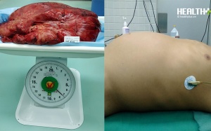 Thoát cảnh 'bụng bầu' sau khi được mổ thành công bướu khủng nặng 7kg