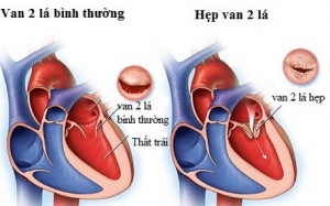 Mắc bệnh hẹp van 2 lá sinh con có nguy hiểm không?