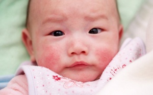 Mẹ cần lưu ý gì khi chăm sóc trẻ bị nẻ má?