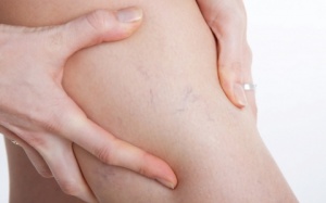 Giãn tĩnh mạch sâu cần làm gì để phòng ngừa đột quỵ?