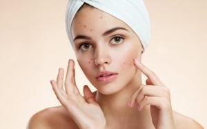 Stress gây ra mụn trứng cá như thế nào?