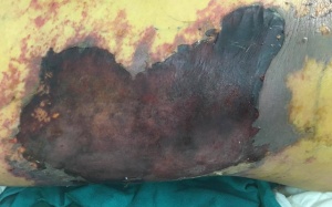 Nguy hiểm khi chữa trị tại nhà: Mũi tiêm “đoạt mạng” người đàn ông hơn 50 tuổi