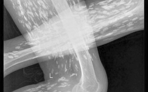 Hoảng hồn sán di chuyển khắp cơ thể, biến người phụ nữ thành 'người gạo'