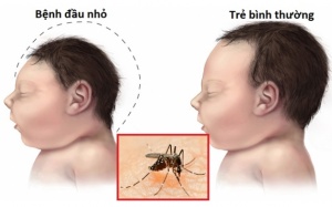 Thái Lan công bố 2 trẻ sinh ra bị đầu nhỏ do virus Zika