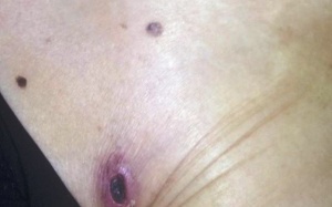 Cụ bà suýt chết vì bị ve mò cắn trúng vùng kín