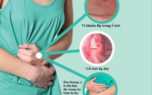 Điều trị viêm dạ dày do vi khuẩn HP như thế nào?