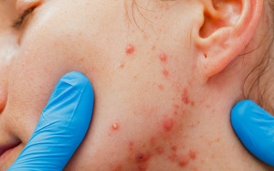 Kem bôi retinol trị mụn trứng cá có tác dụng phụ gì?