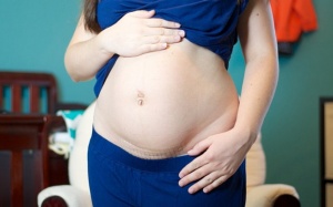 Sinh mổ và những điều cần biết sau phẫu thuật