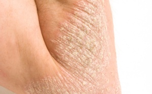 Bệnh vẩy nến 'hoành hành' trên các bộ phận cơ thể như thế nào?