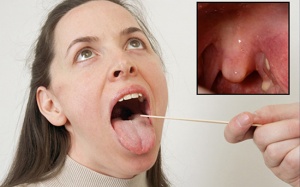 Bị viêm amidan hốc mủ có nên dùng Tiêu Khiết Thanh?