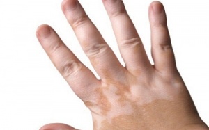 Điều trị bạch biến như thế nào?